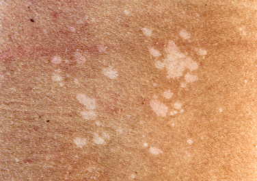 Tinea versicolor