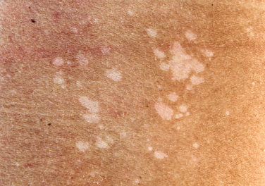 Pityriasis_Versicolor